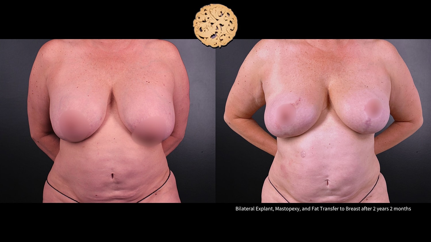 Breast Explant (Implant Removal) Before & After