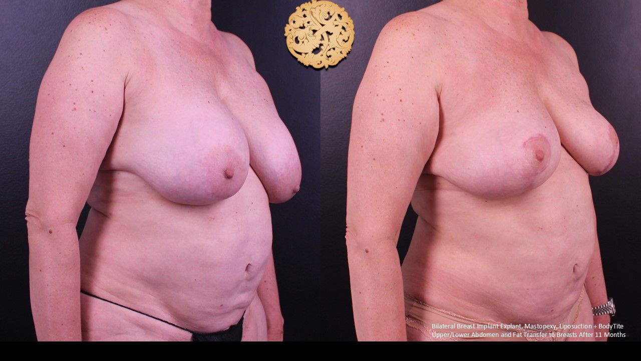 Breast Implant Removal Before & After