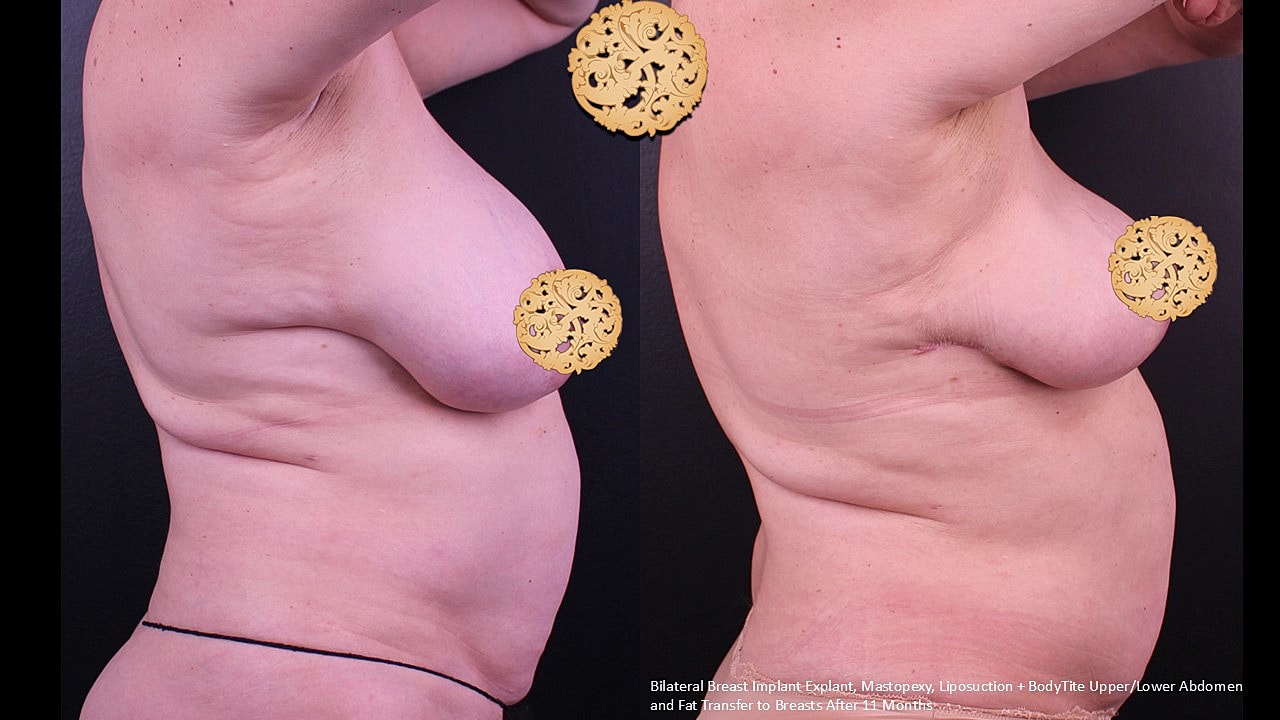 Breast Explant (Implant Removal) Before & After
