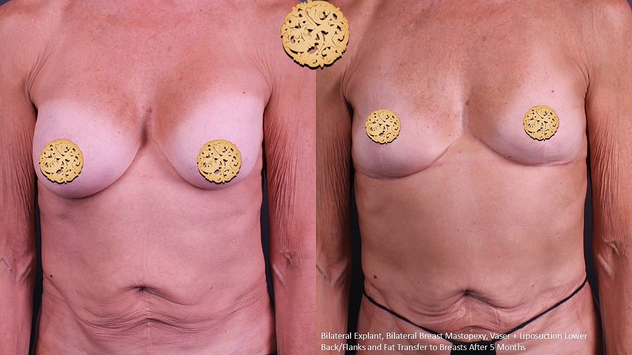 Breast Explant (Implant Removal) Before & After