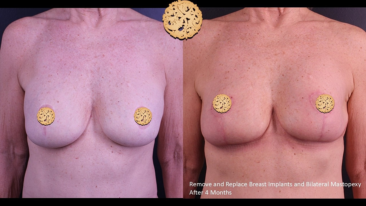 Breast surgery results: before and after comparison.