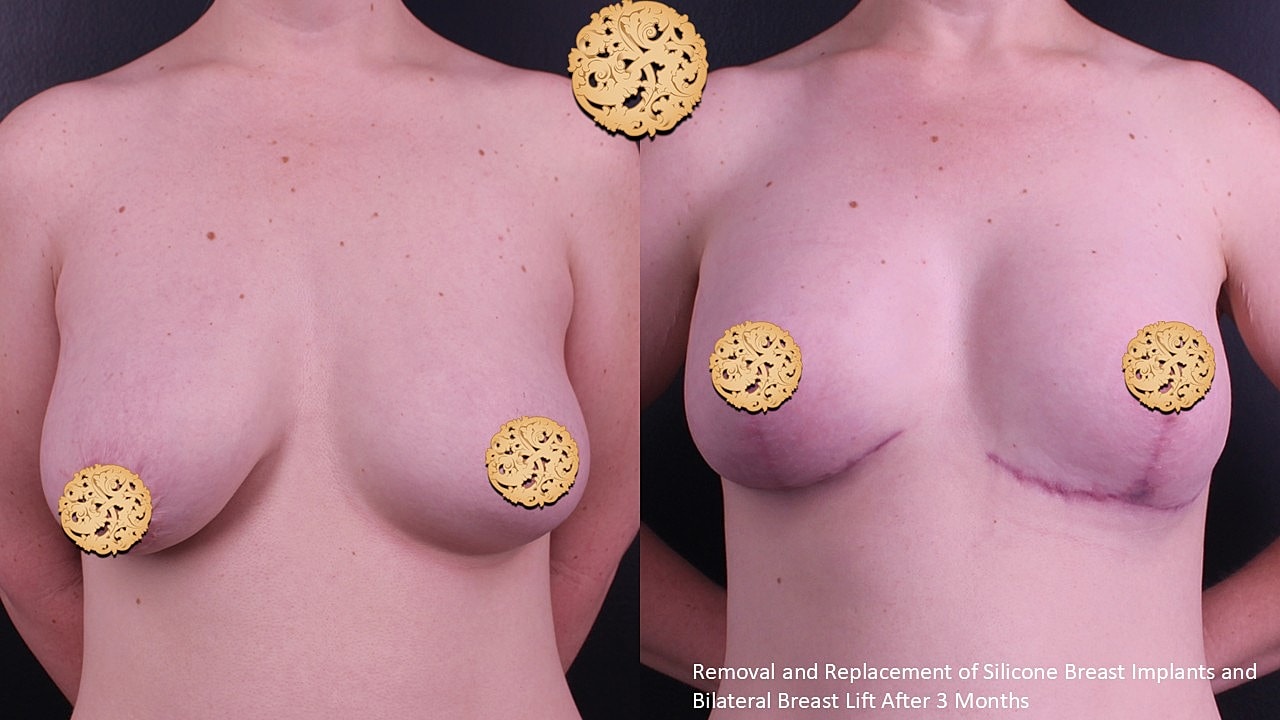 Breast Implant Removal Before & After