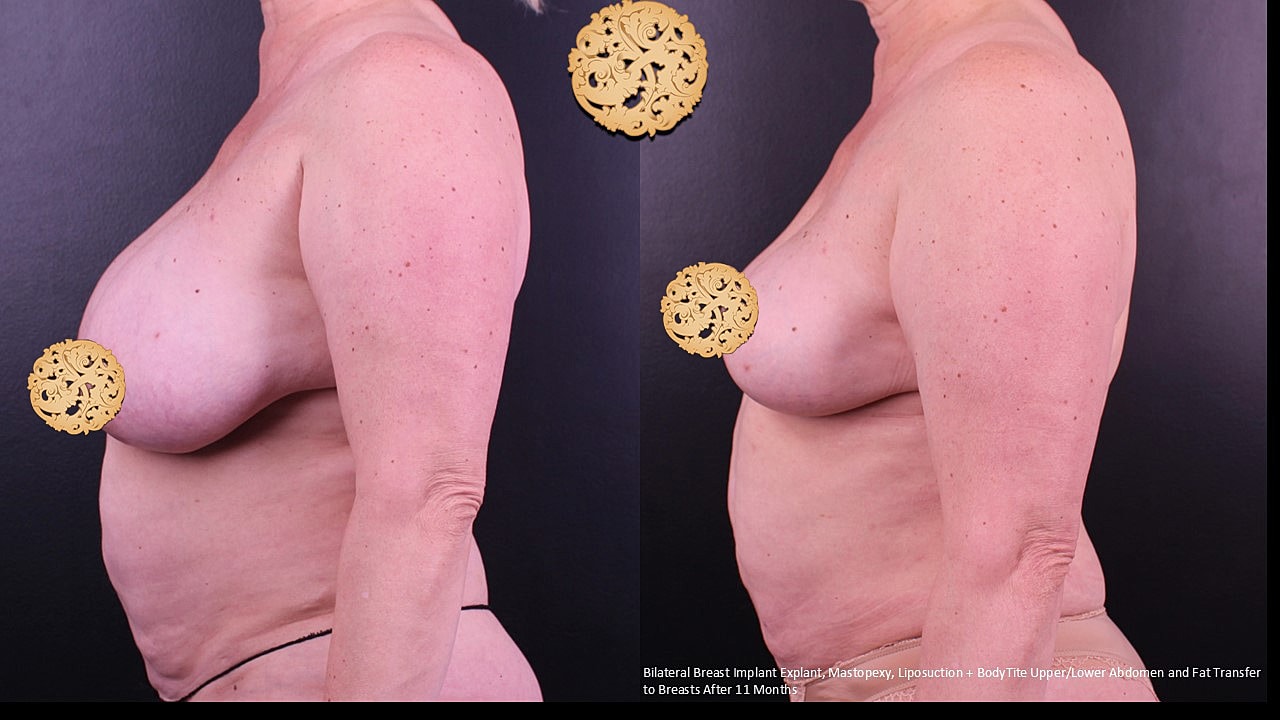 Breast Explant (Implant Removal) Before & After