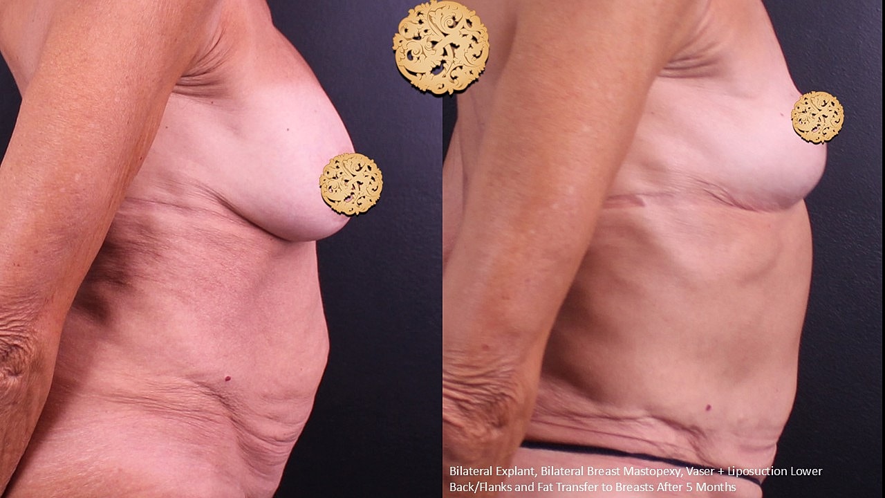 Breast Explant (Implant Removal) Before & After