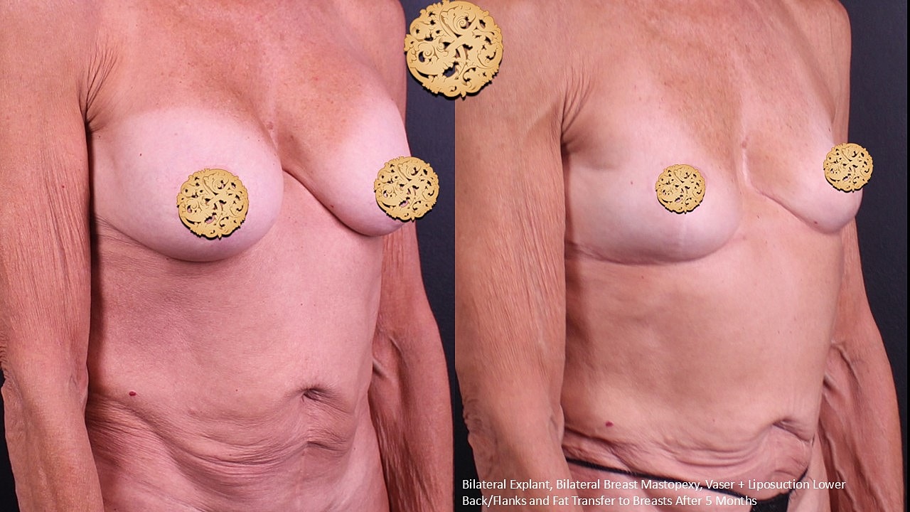 Breast Explant (Implant Removal) Before & After