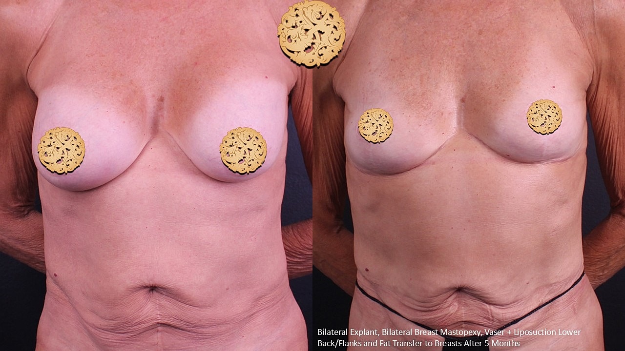 Breast Explant (Implant Removal) Before & After