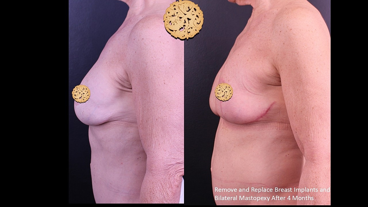 Breast reconstruction before and after treatment.