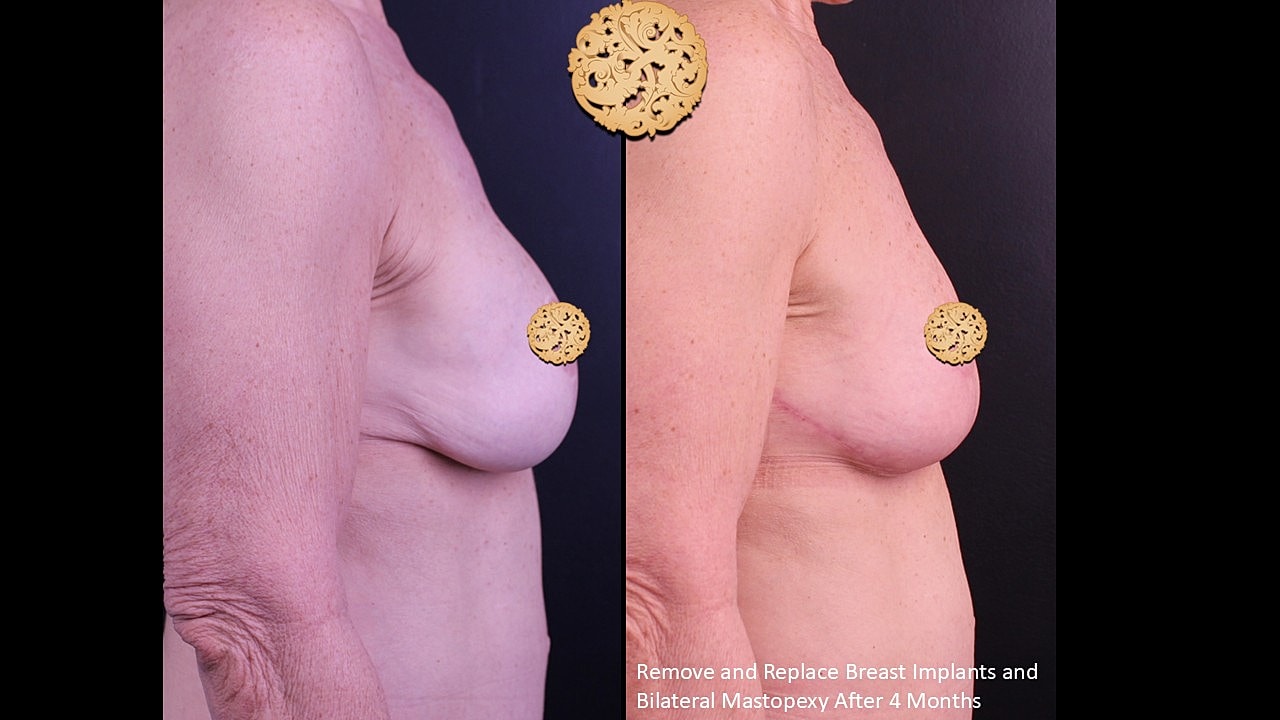 Breast surgery before and after images comparison.
