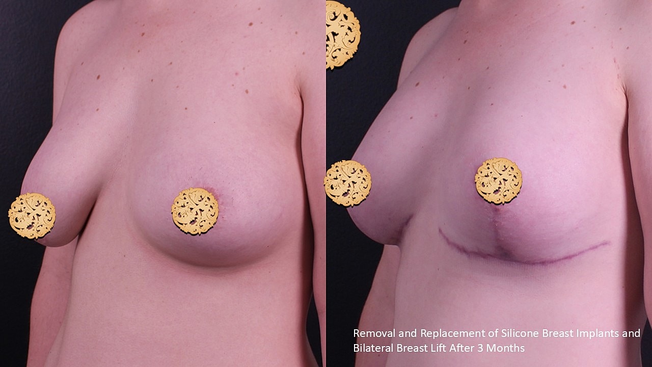 Breast Implant Removal Before & After