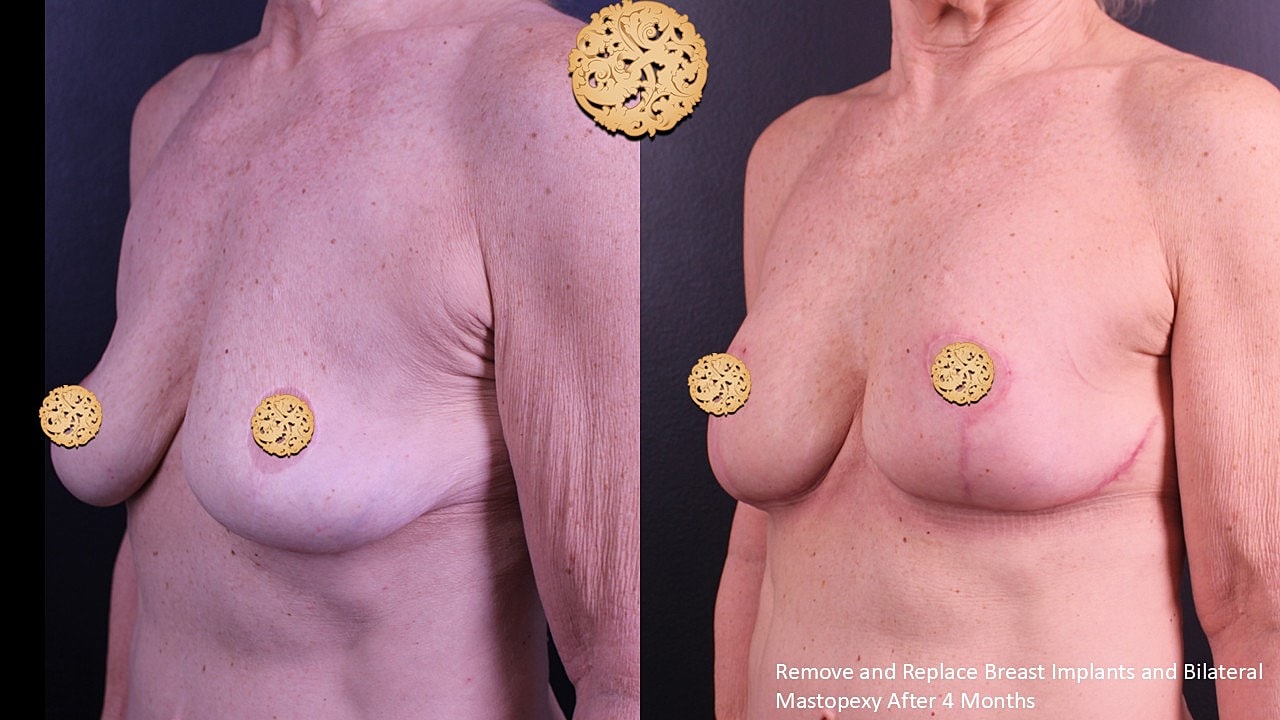 Breast surgery before and after comparison.