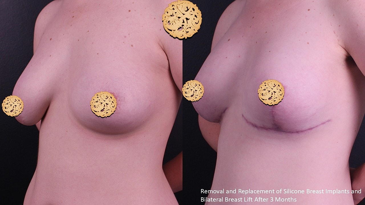 Breast Implant Removal Before & After