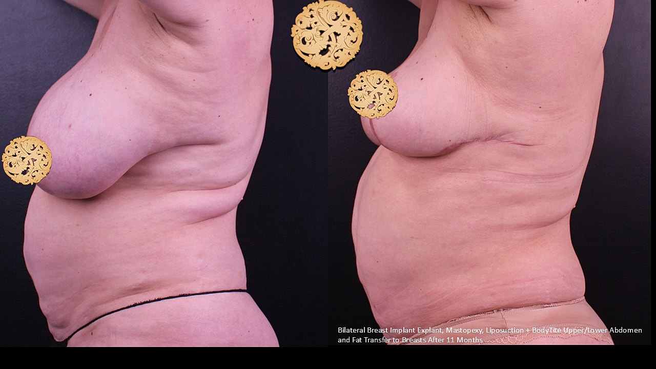Breast Explant (Implant Removal) Before & After