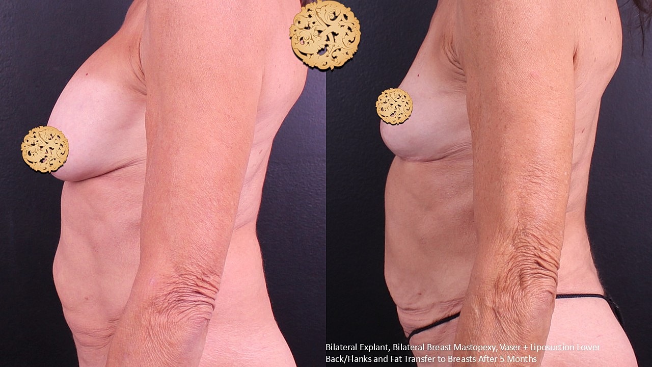 Breast Explant (Implant Removal) Before & After