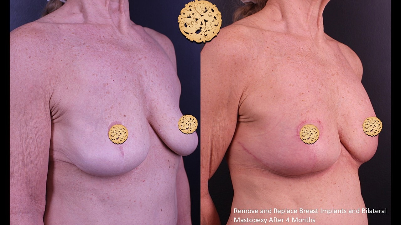 Before and after breast surgery comparison image.