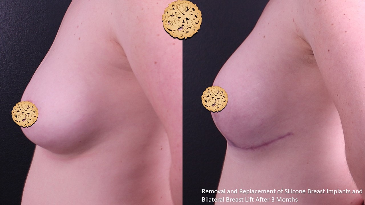 Breast Implant Removal Before & After