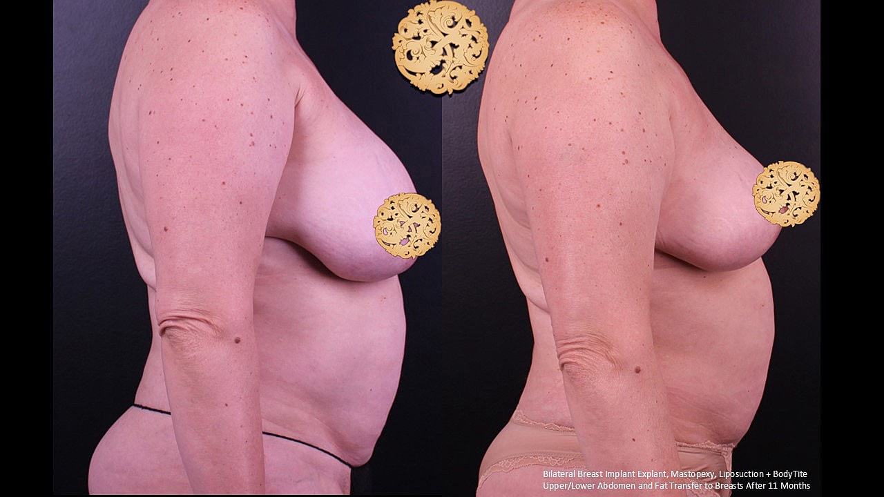 Breast Explant (Implant Removal) Before & After