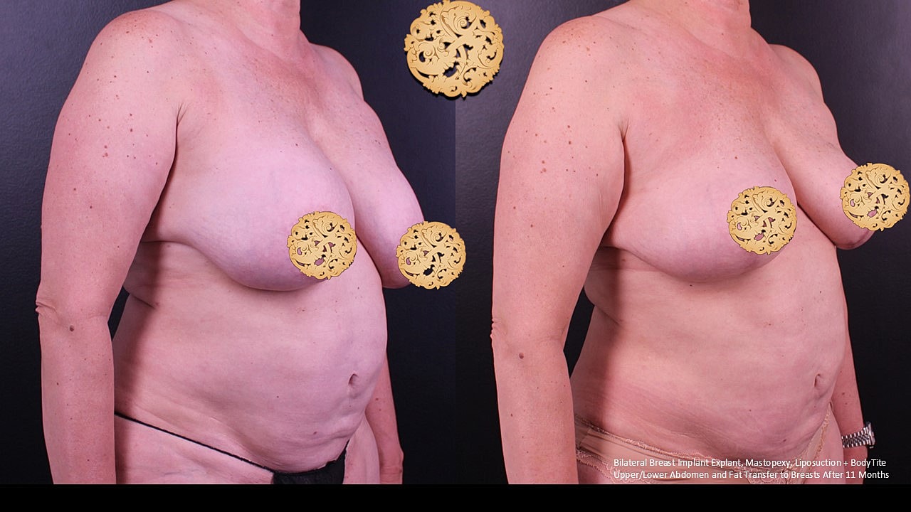 Breast Explant (Implant Removal) Before & After