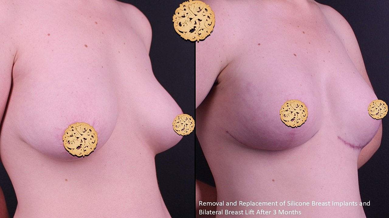 Breast Implant Removal Before & After