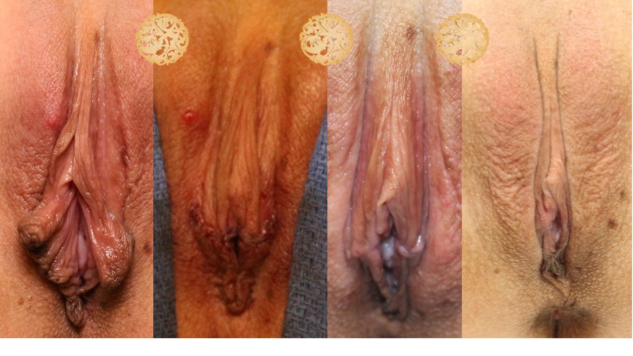 Labiaplasty Before & After