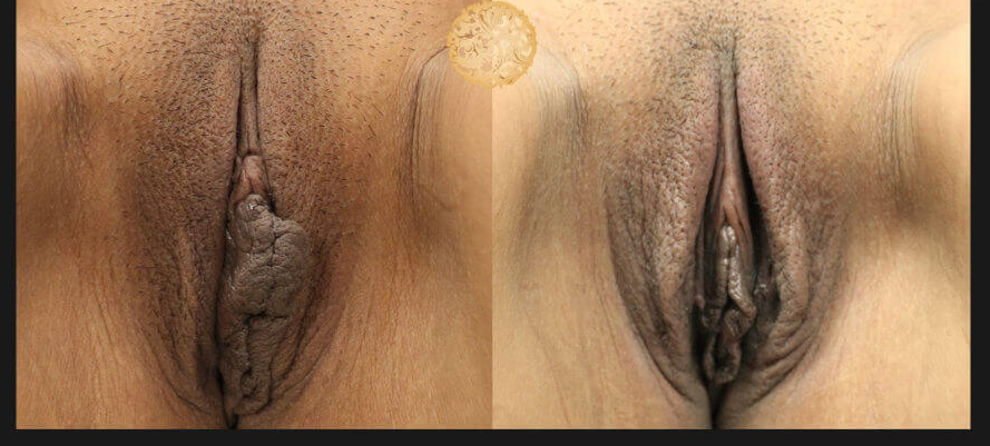 Labiaplasty Before & After