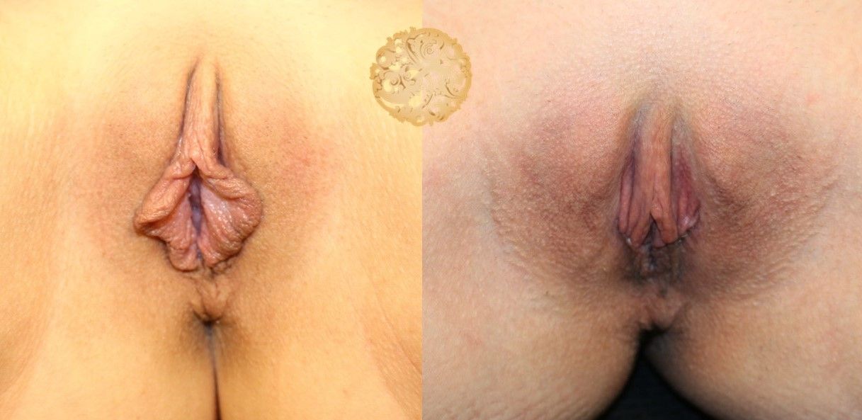 Labiaplasty Before & After