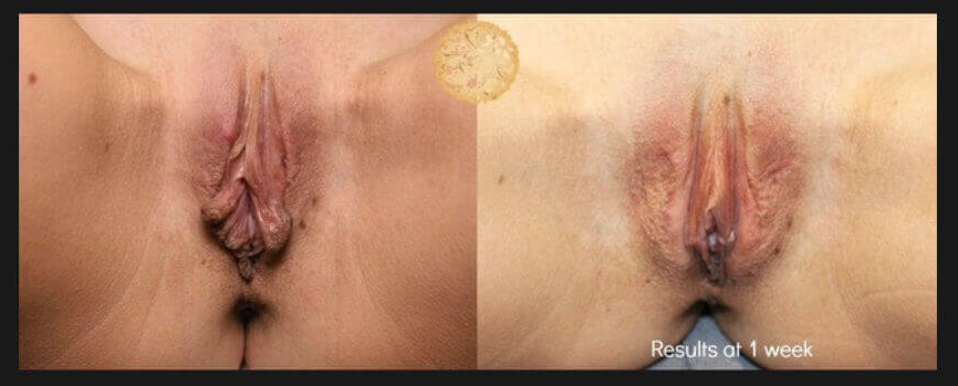 Labiaplasty Before & After