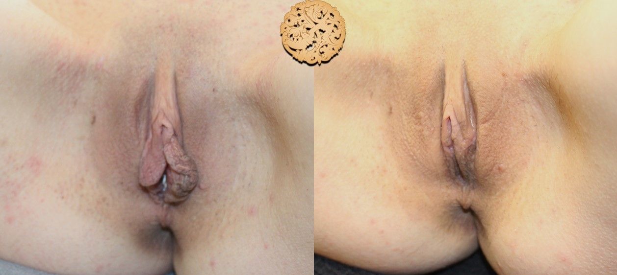 Labiaplasty Before & After