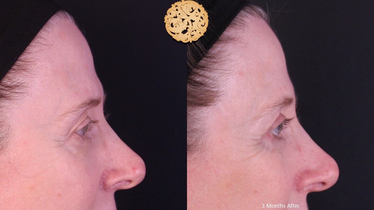 Blepharoplasty Before & After