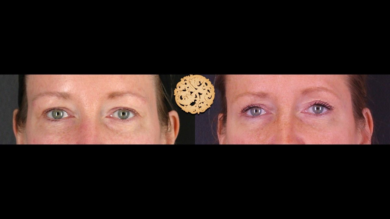 Blepharoplasty Before & After