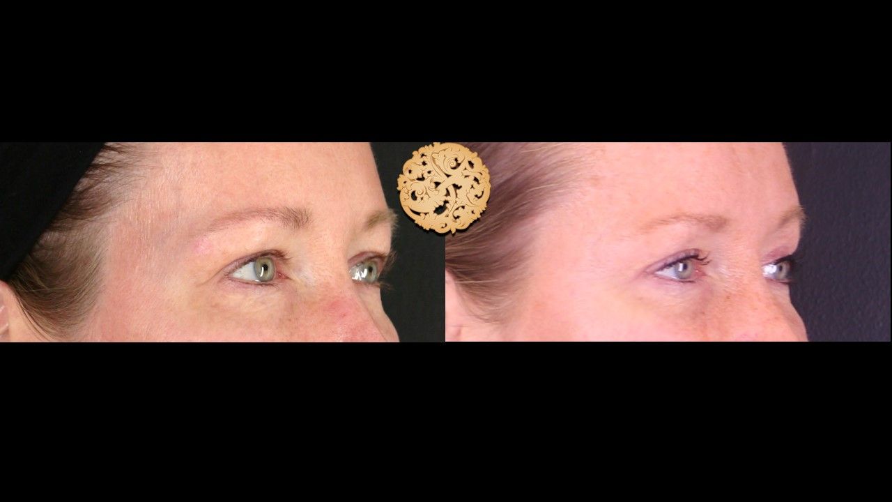 Blepharoplasty Before & After