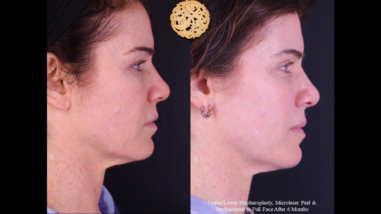 Blepharoplasty Before & After