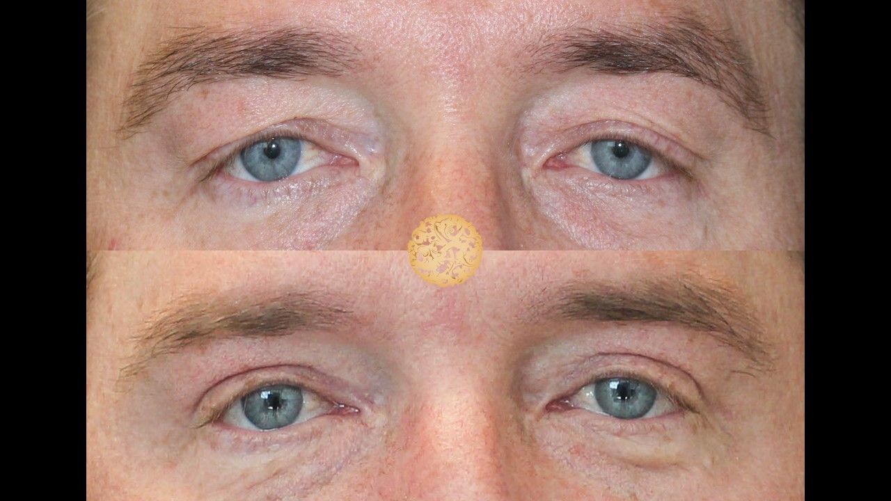 Blepharoplasty Before & After