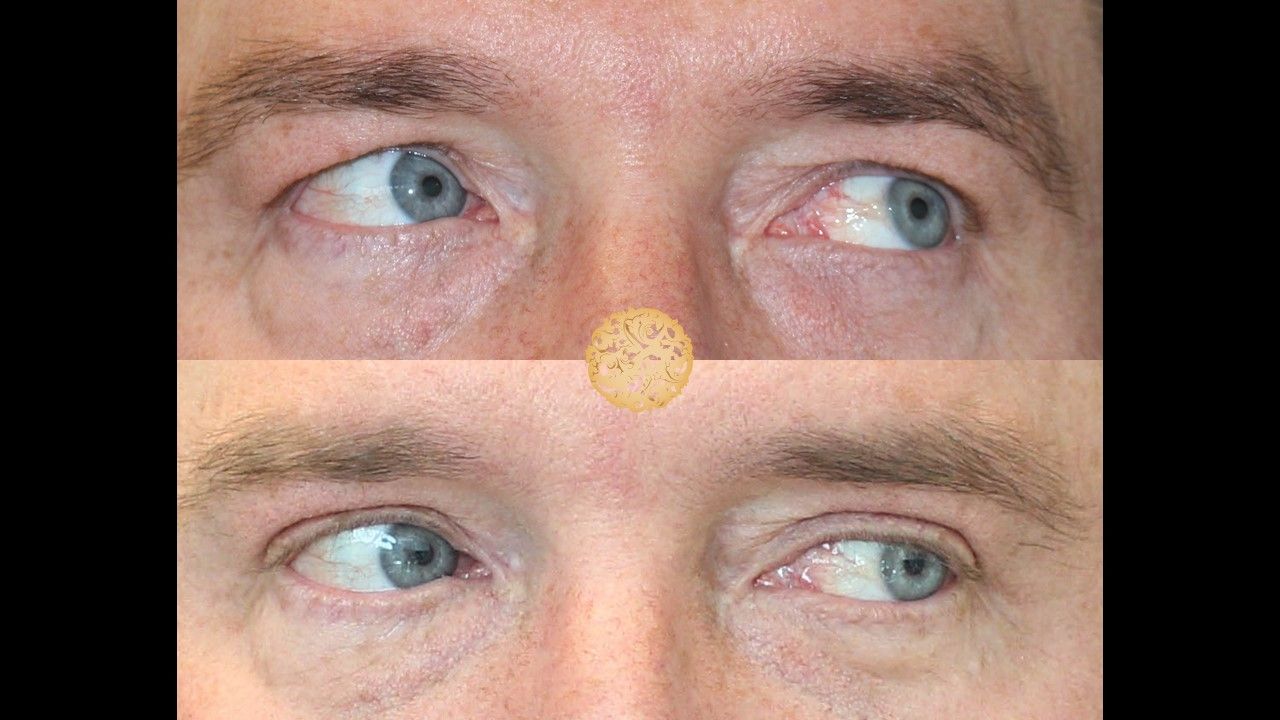 Blepharoplasty Before & After