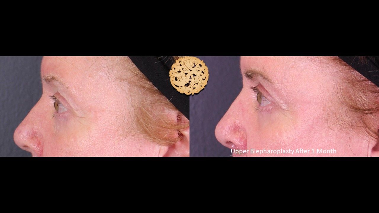 Blepharoplasty Before & After