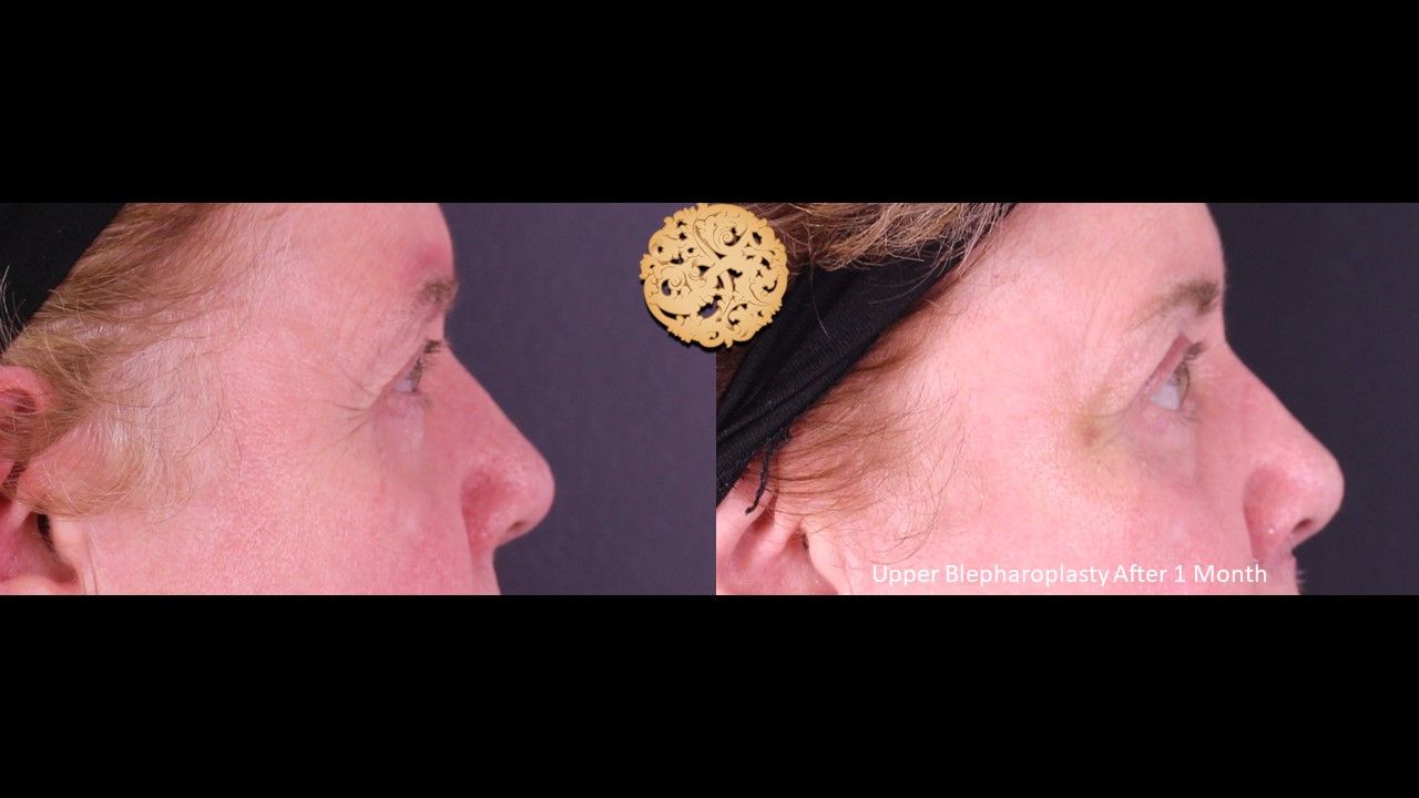 Blepharoplasty Before & After