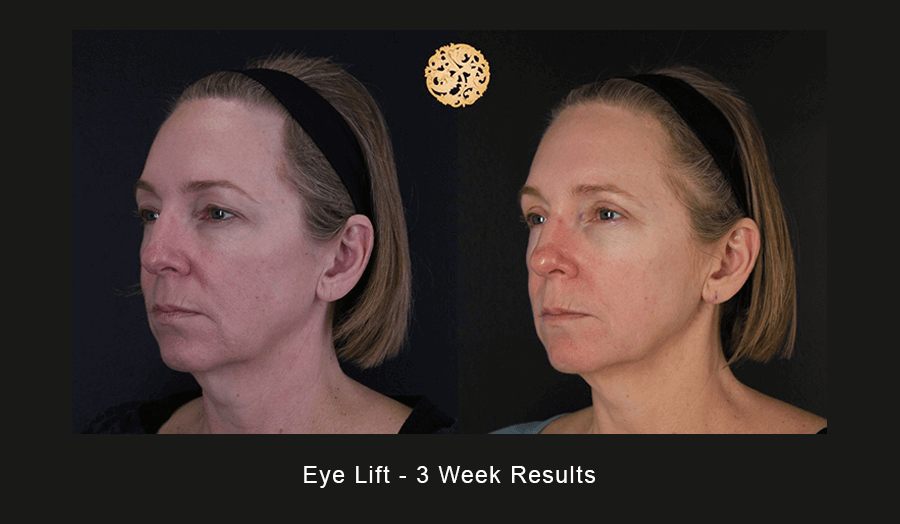Blepharoplasty Before & After
