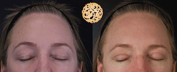 Blepharoplasty Before & After