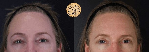 Blepharoplasty Before & After