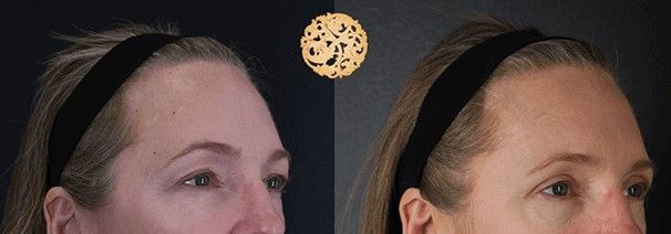 Blepharoplasty Before & After