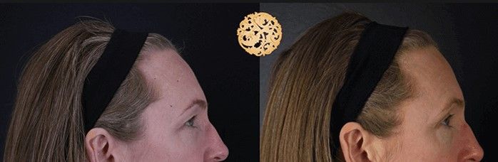 Blepharoplasty Before & After