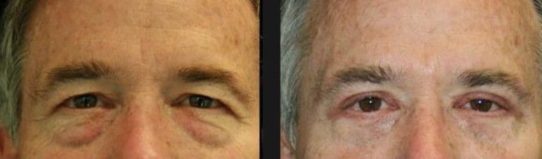 Blepharoplasty Before & After