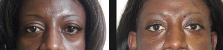 Blepharoplasty Before & After