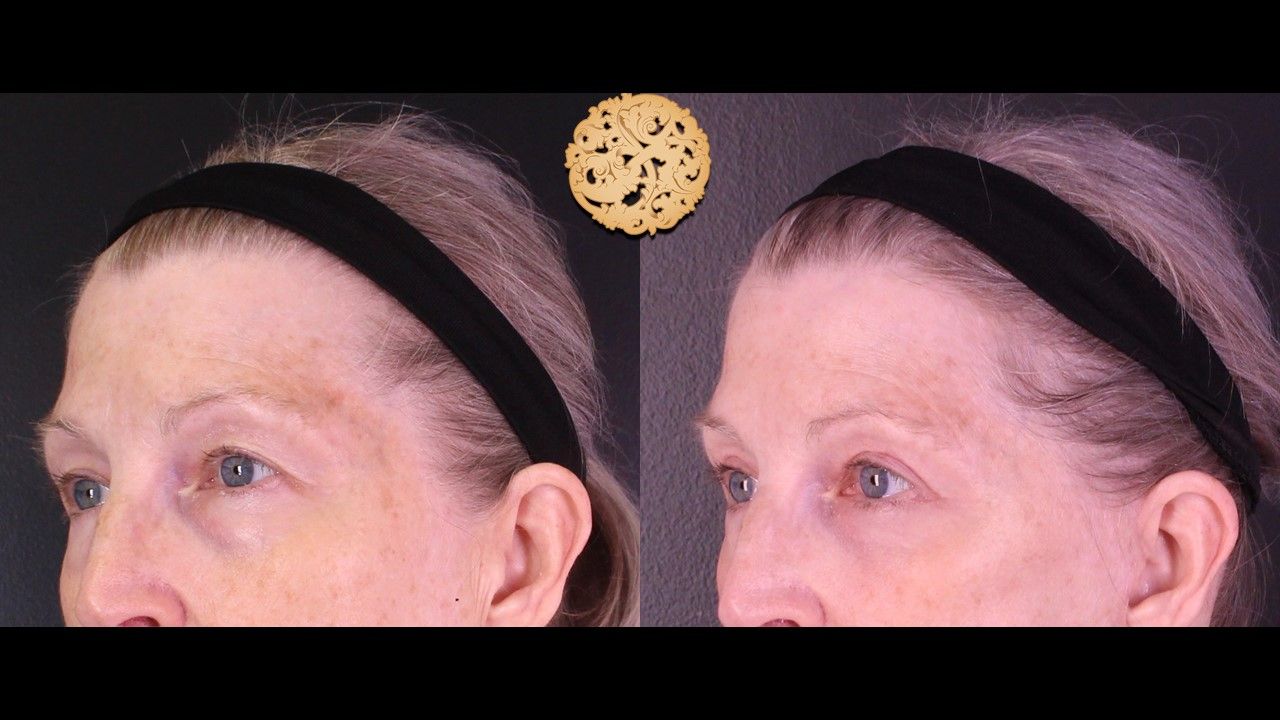 Blepharoplasty Before & After