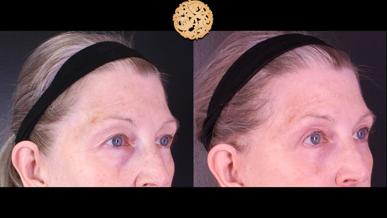 Blepharoplasty Before & After