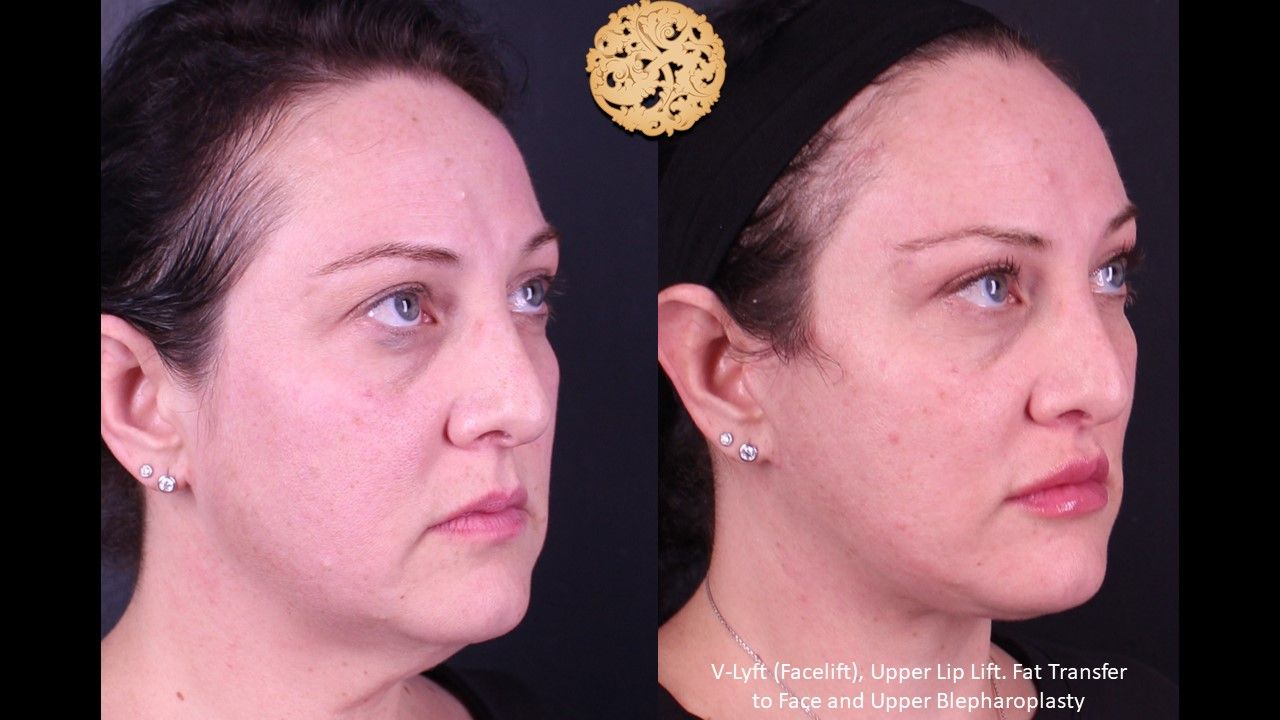 Blepharoplasty Before & After