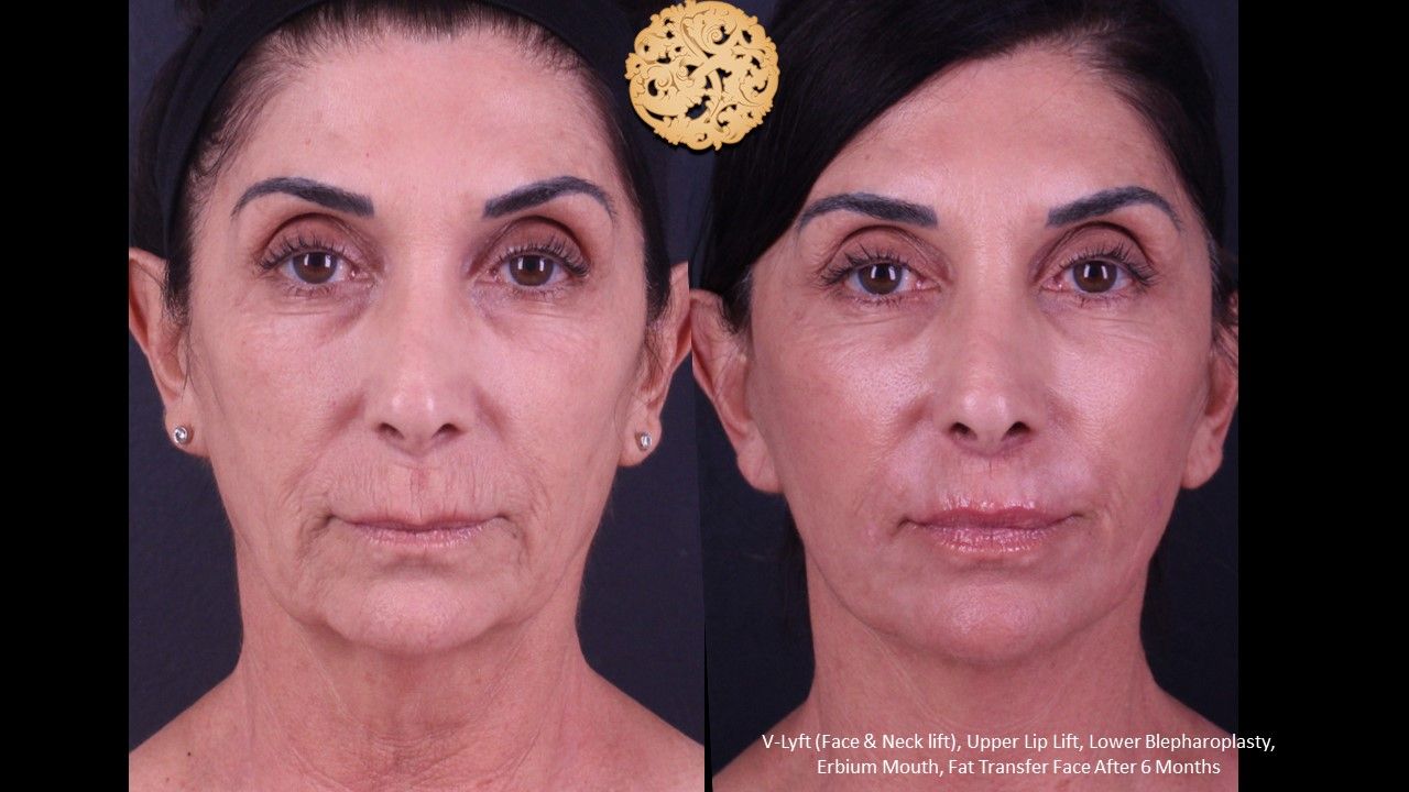 Blepharoplasty Before & After