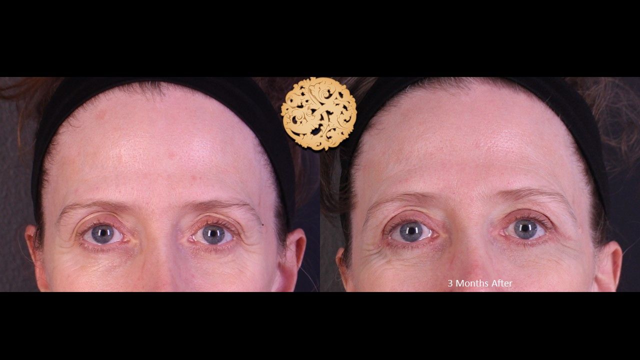 Blepharoplasty Before & After