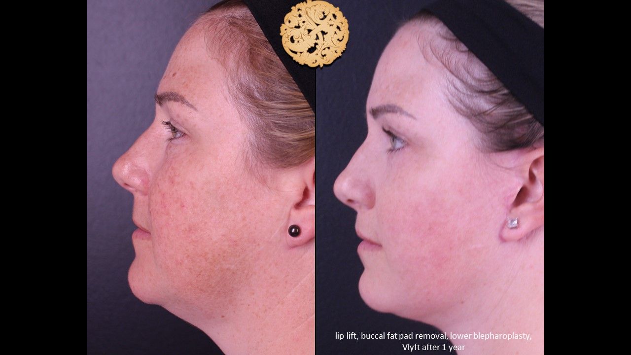 Blepharoplasty Before & After