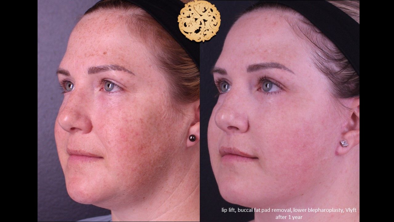 Blepharoplasty Before & After