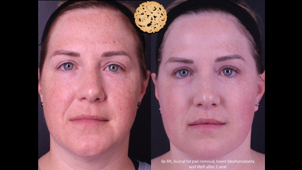 Blepharoplasty Before & After